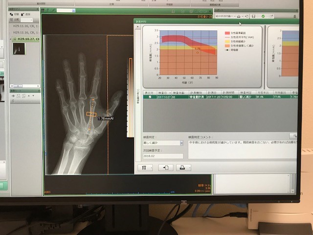 骨密度測定 骨密度測定